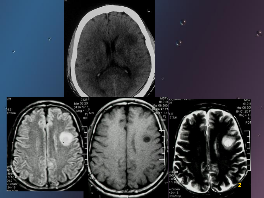 肿瘤样脱髓鞘病变影像特征以及鉴别诊断幻灯片课件.ppt_第2页