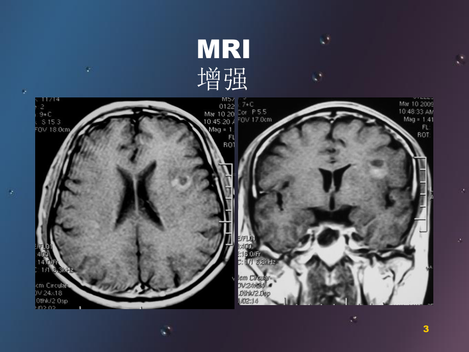 肿瘤样脱髓鞘病变影像特征以及鉴别诊断幻灯片课件.ppt_第3页