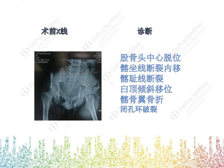 3D打印在复杂骨盆骨折的应用课件.pptx_第3页