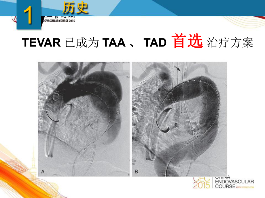 TEVAR手术的并发症及处置策略课件.pptx_第3页