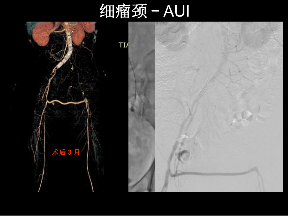 EVAR处理复杂近端瘤颈AAA的支架选择课件.pptx_第3页