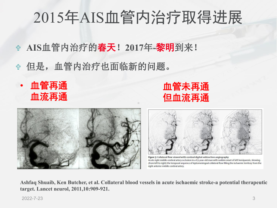 丁苯酞-AIS侧支循环的基础研究及临床影像评估的优化策略课件.pptx_第3页