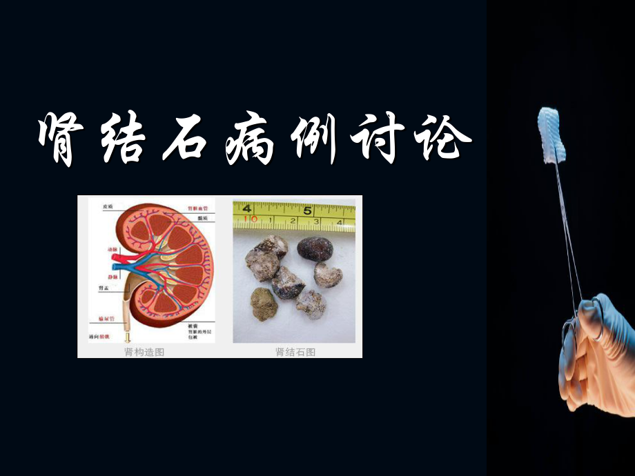 肾结石-多囊肾病例讨论PPT医学课件.ppt_第1页