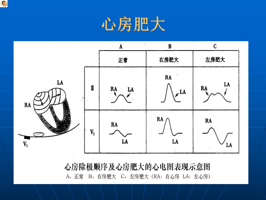 心电图心房室大和心梗课件.ppt_第3页