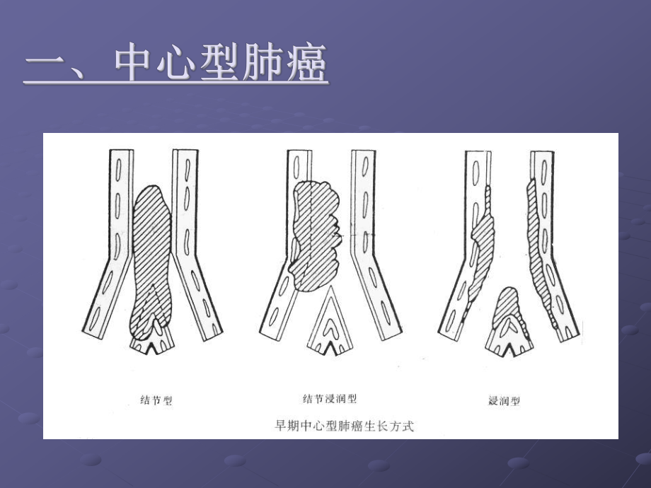 肺癌影像诊断讲课医学PPT课件.ppt_第3页