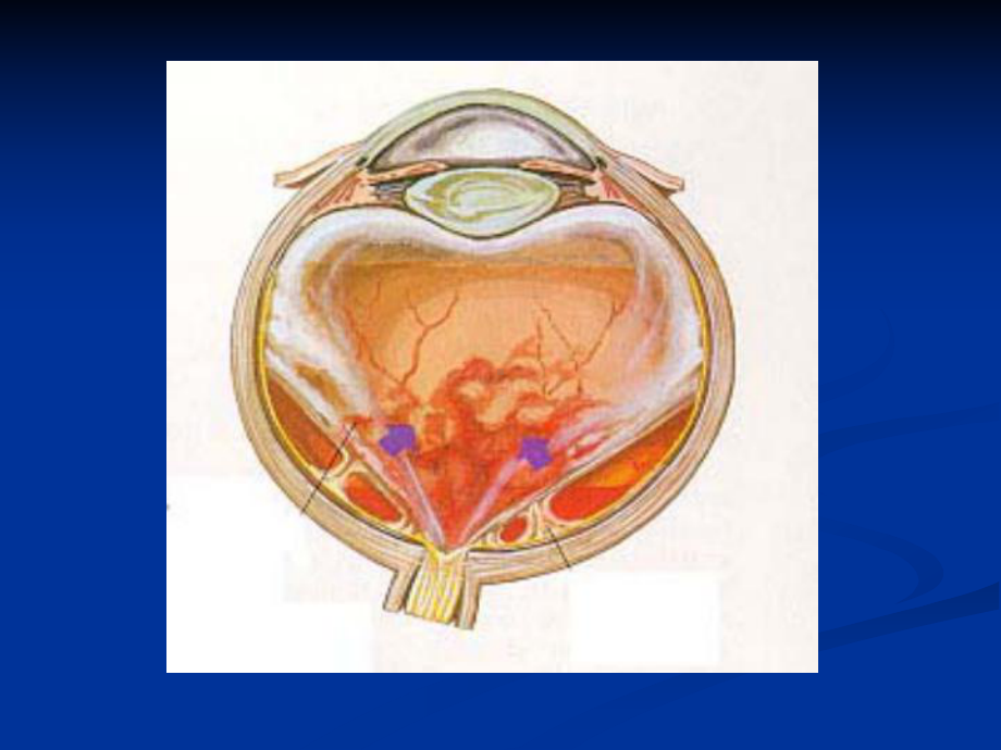 增殖性玻璃体视网膜病变课件.ppt_第2页