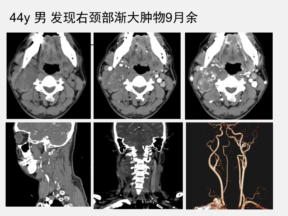 CBT-影像学诊断课件.ppt_第1页