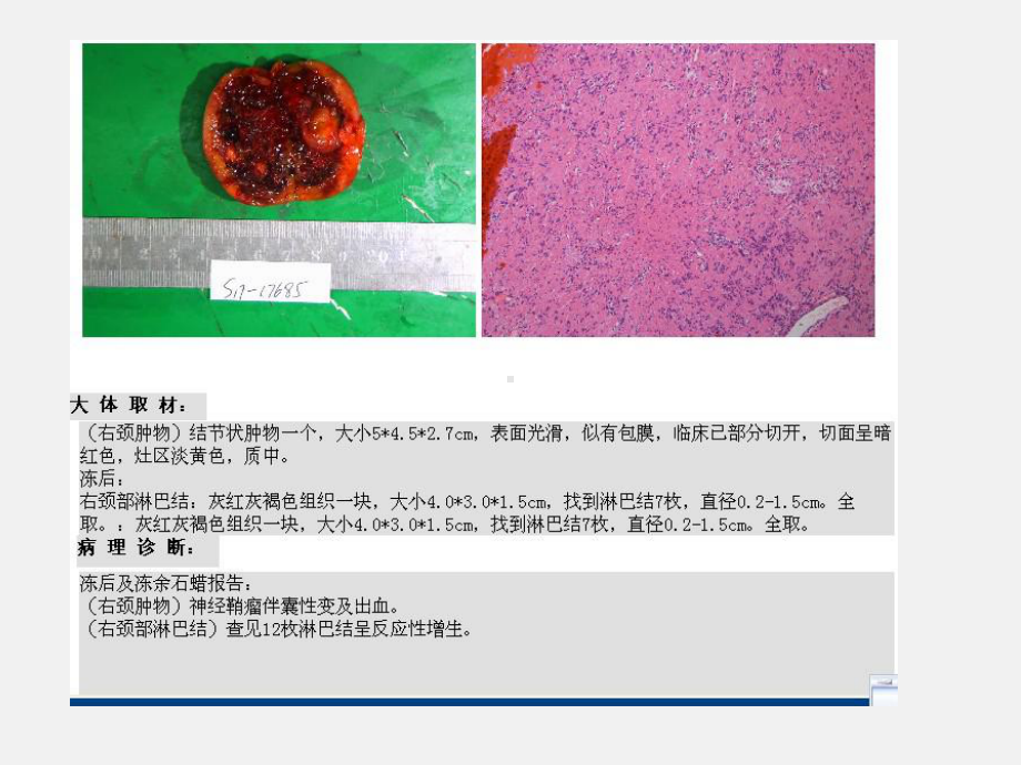 CBT-影像学诊断课件.ppt_第3页