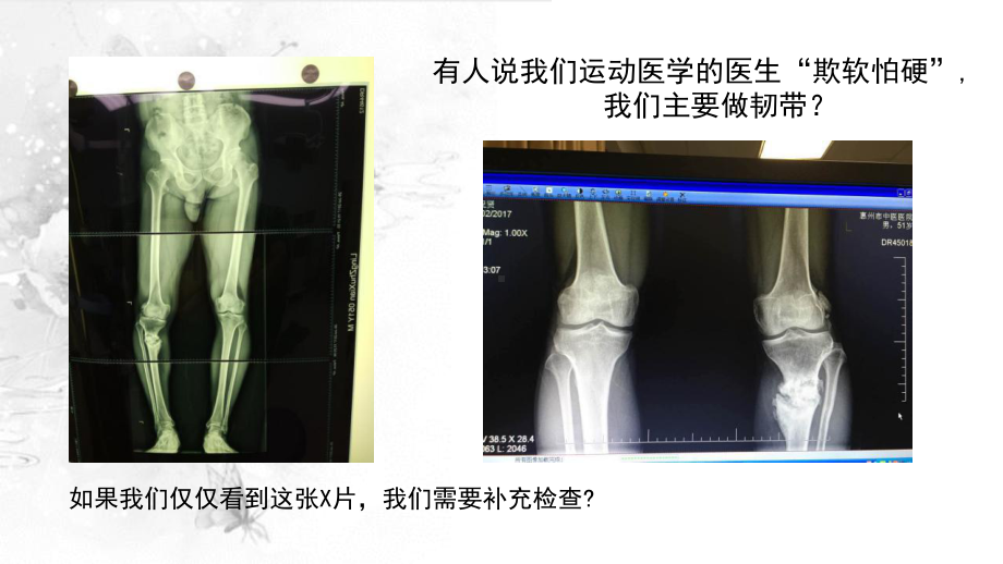 截骨术在不稳定膝关节的作用课件.pptx_第2页