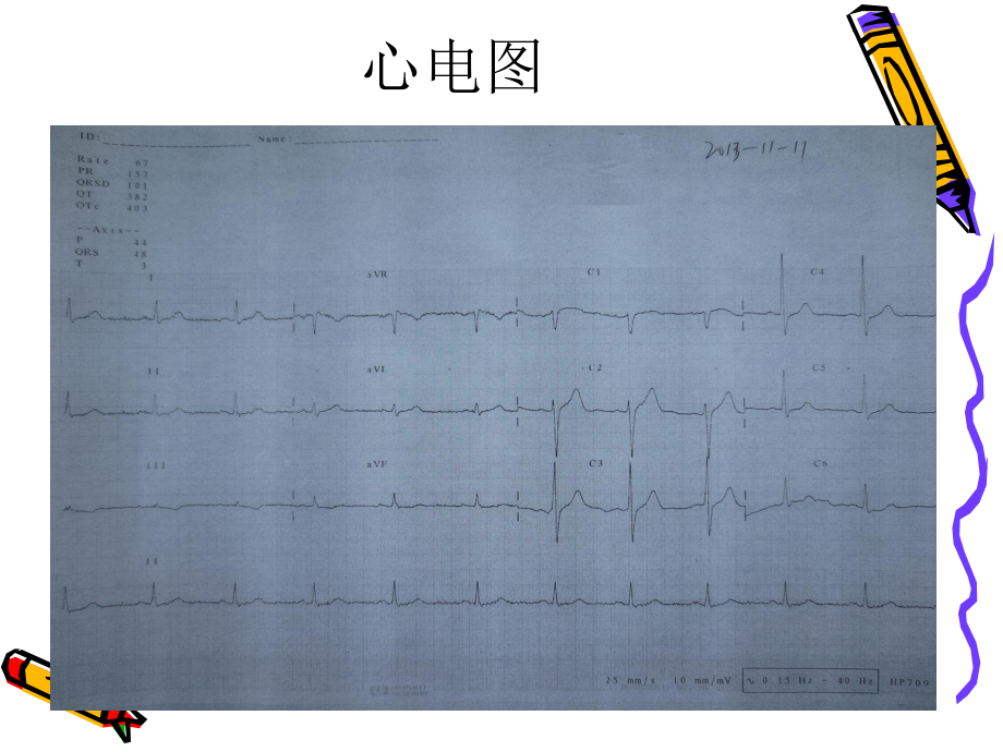 成功抢救医源性左主干-升主动脉夹层一例课件.ppt_第3页