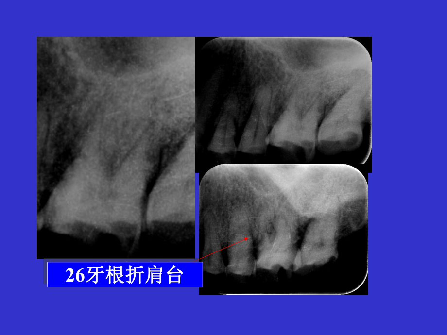 多种根折锥形束CT影像表现课件.ppt_第2页