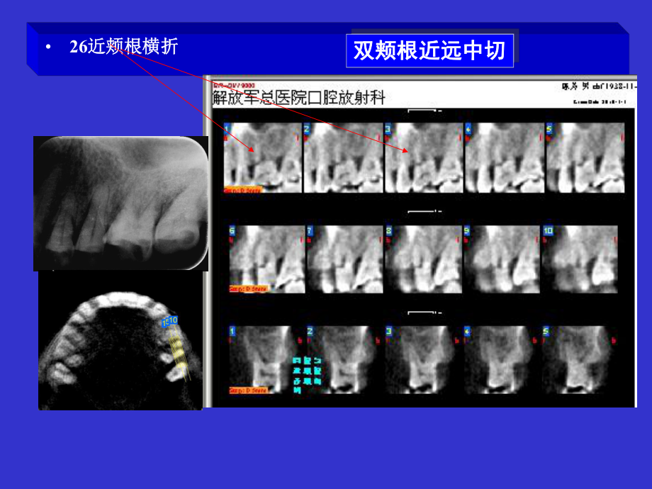 多种根折锥形束CT影像表现课件.ppt_第3页