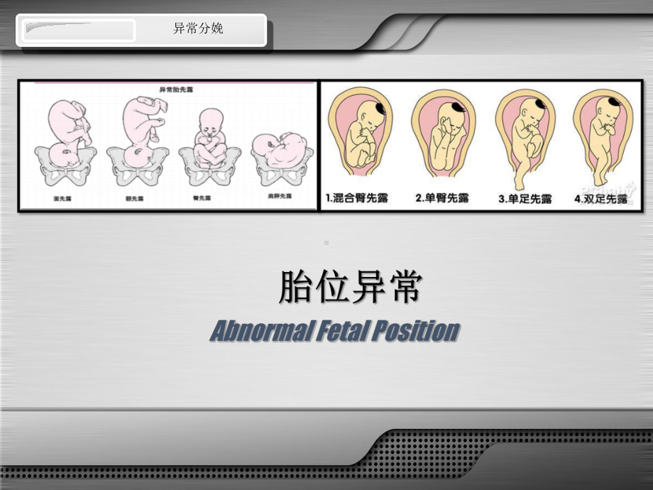 胎位异常妇产科医学PPT课件.ppt_第1页