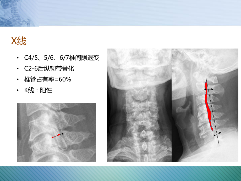 EC-spine病例讨论-脑脊液漏课件.pptx_第3页