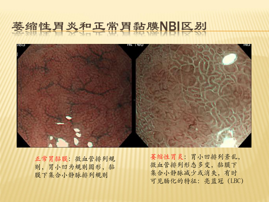 NBI-ME诊断早期胃癌技巧课件.ppt_第3页