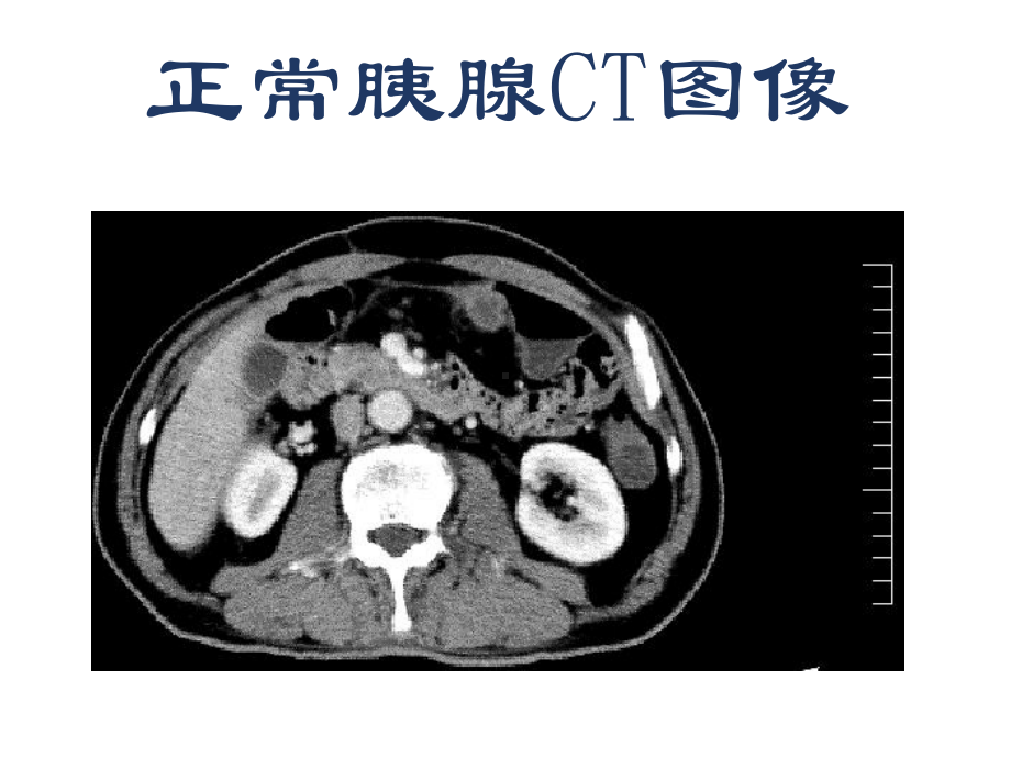 急性胰腺炎-(4S)课件.ppt_第3页