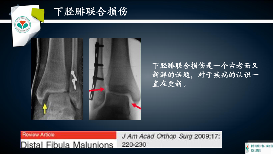 双Endobutton钢板治疗下胫腓联合损伤的课件.ppt_第2页