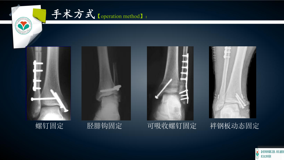 双Endobutton钢板治疗下胫腓联合损伤的课件.ppt_第3页