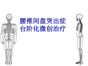 腰椎间盘突出症台阶化微创治疗课件.ppt