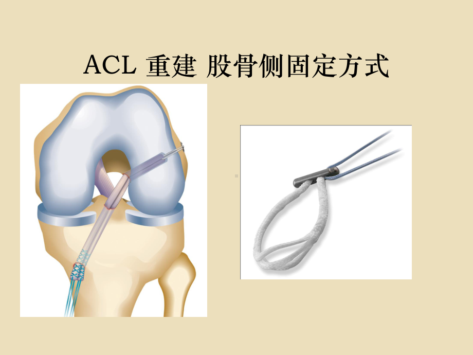 前交叉韧带重建课件.pptx_第2页