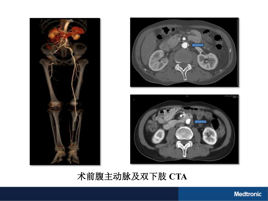 一例累及髂股及膝下病变的TASC-IID级复杂下肢动脉病变治疗体会课件.pptx_第3页