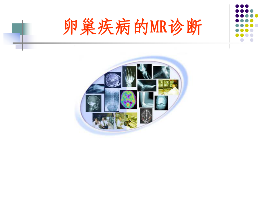 卵巢疾病的MR诊断课件.ppt_第1页