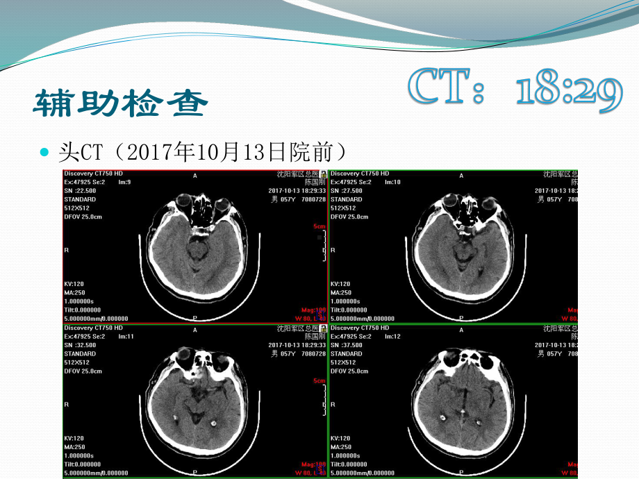 急诊介入处置症状波动颈动脉夹层一例课件.pptx_第3页