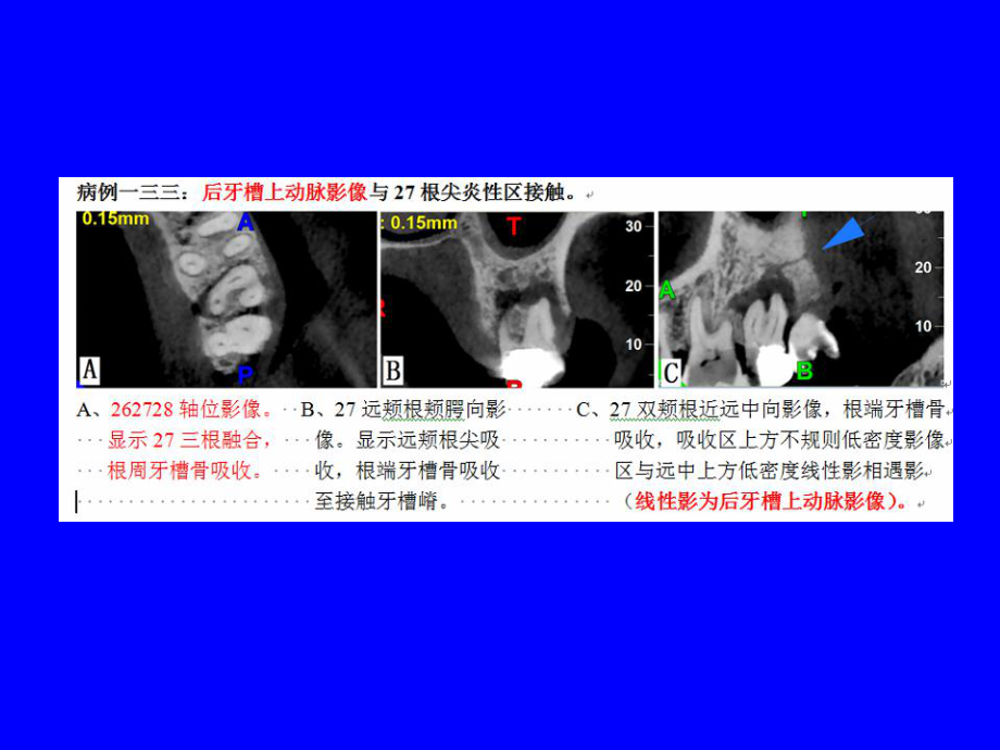 CBCT寻找无自主定位不适感原因课件.ppt_第3页