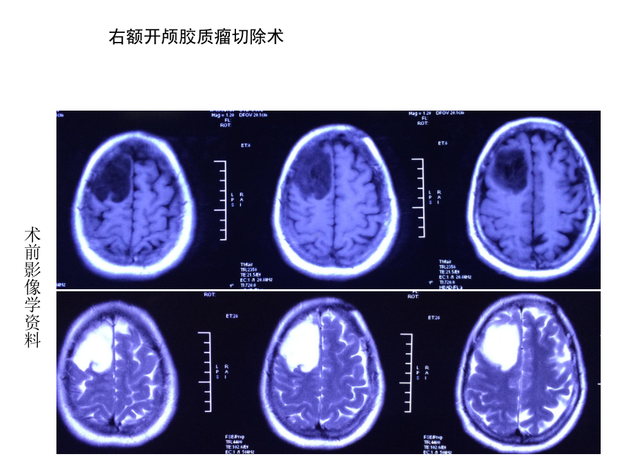 右额胶质瘤切除术课件.ppt_第3页