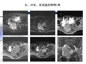 卵巢卵泡膜--纤维瘤组肿瘤课件.ppt