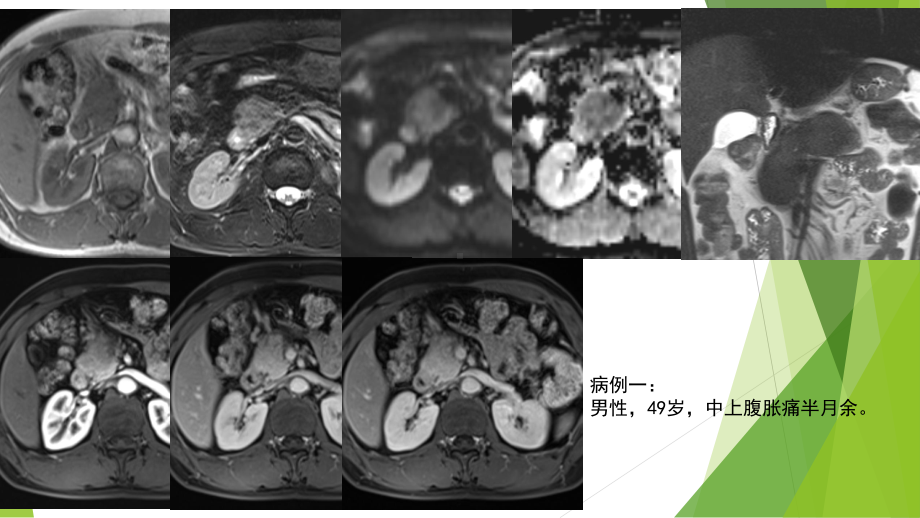 IgG4相关性自身免疫性胰腺炎课件.pptx_第1页