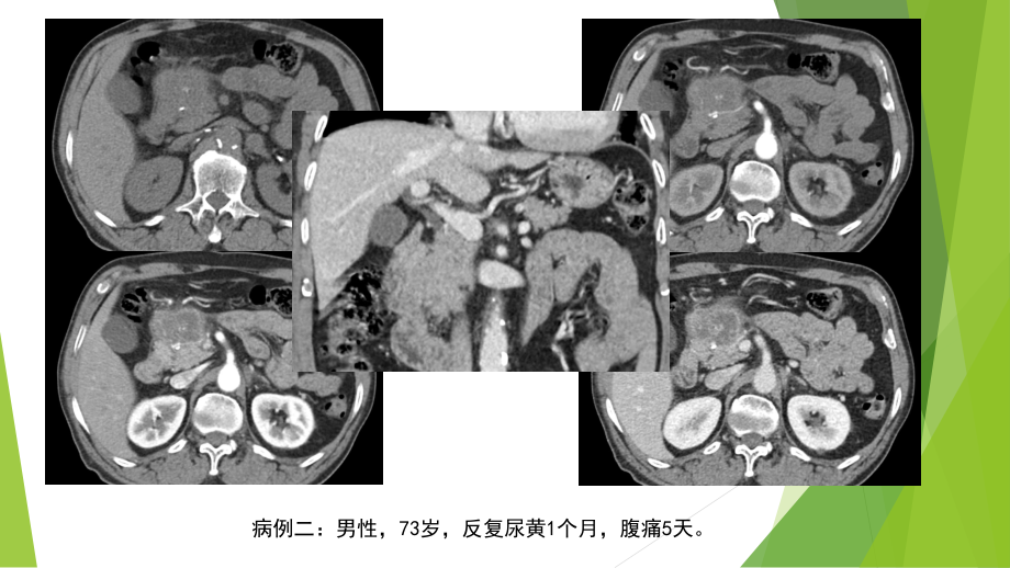 IgG4相关性自身免疫性胰腺炎课件.pptx_第2页