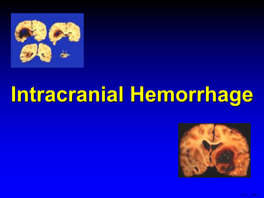 IntracranialHemorrhage脑出课件(PPT 55页).pptx_第1页