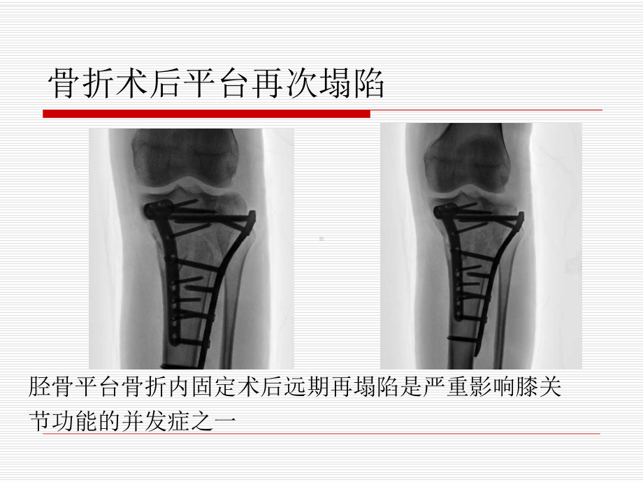 胫骨平台骨折内固定术后再塌陷的相关因素分析课件.ppt_第3页