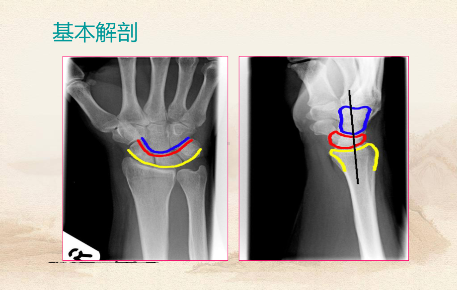 腕关节损伤MRI课件.pptx_第3页