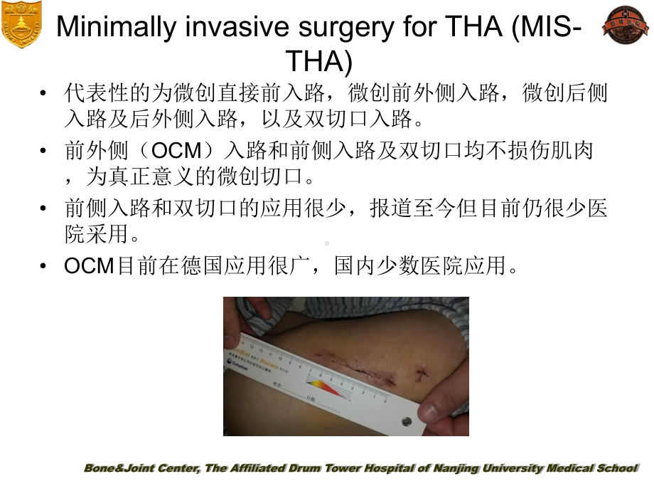 ocm入路小切口全髋关节置换-ppt课件.ppt_第3页