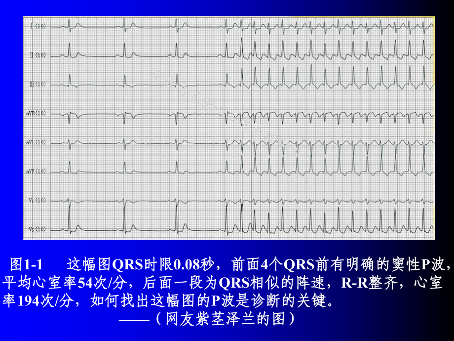 P波的识别与相关病例讨论之一PPT课件.ppt_第3页