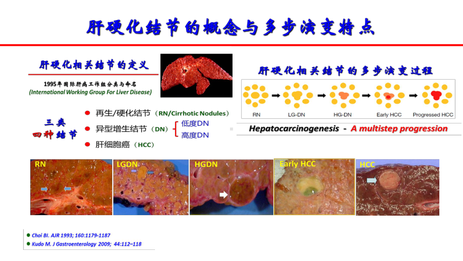 肝硬化相关结节和早期肝癌的影像学评价课件.pptx_第3页