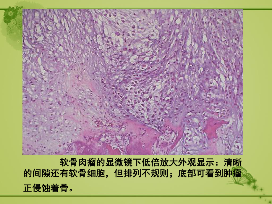 软骨肉瘤的病理及影像学表现课件.ppt_第3页