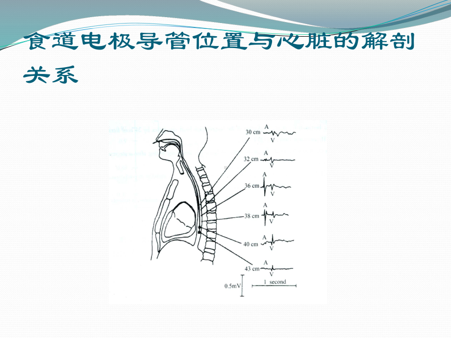 食道心电图的临床应用课件.ppt_第3页