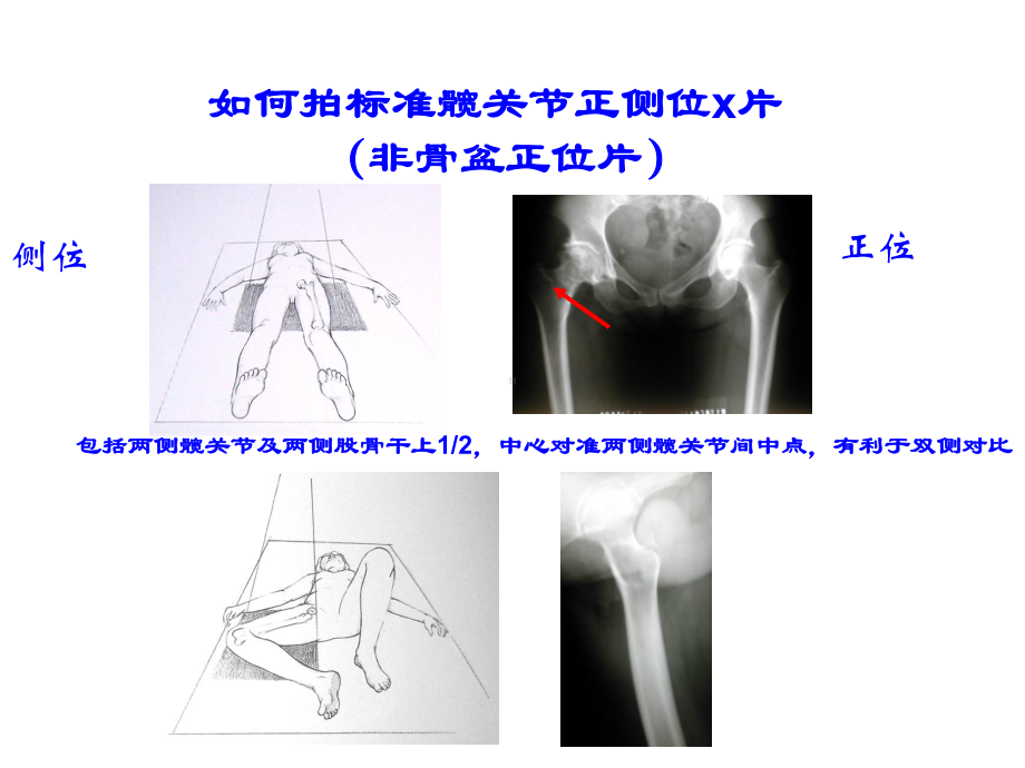 髋关节置换假体模版的使用课件.ppt_第1页