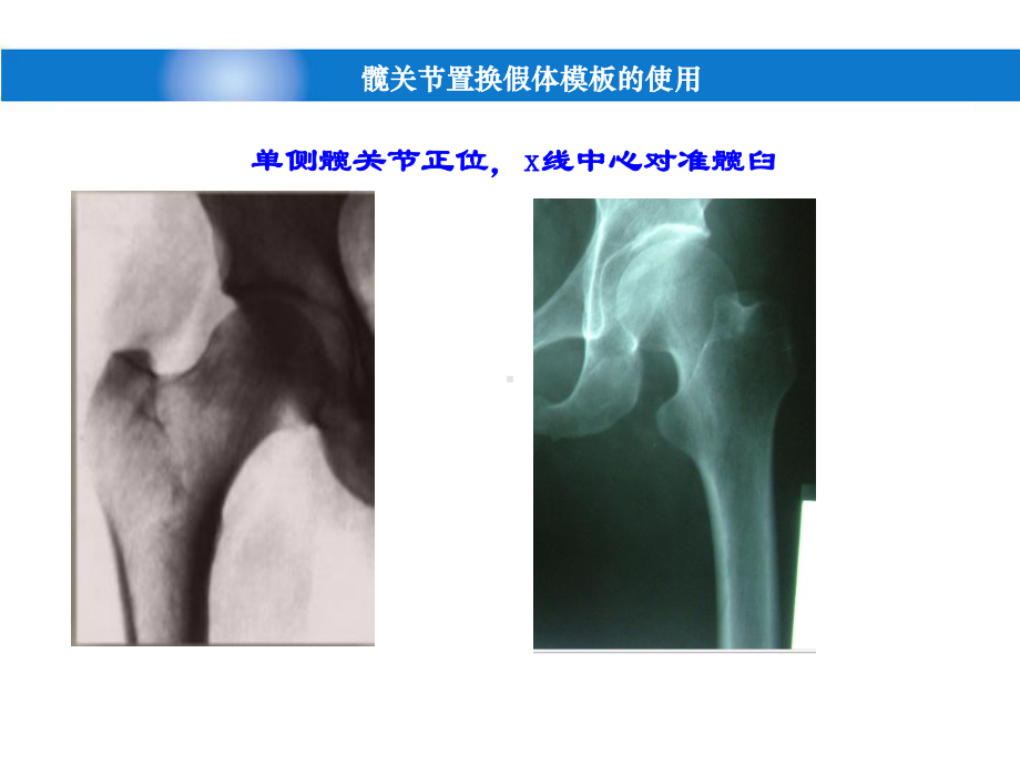 髋关节置换假体模版的使用课件.ppt_第2页