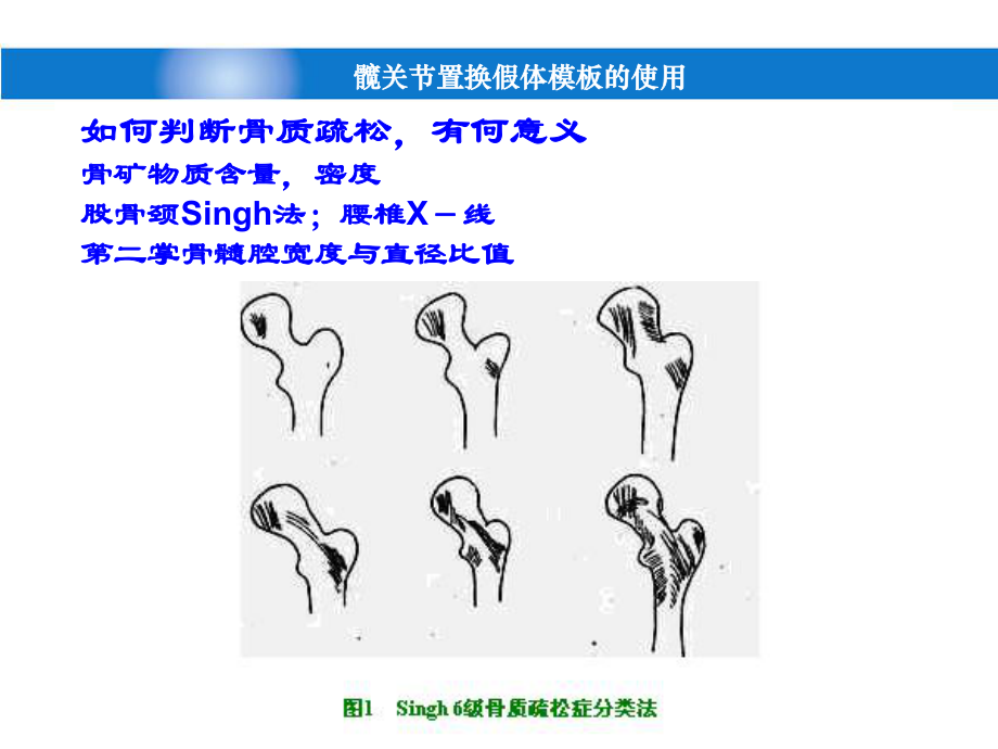 髋关节置换假体模版的使用课件.ppt_第3页