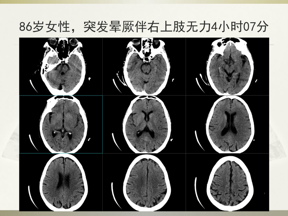 脑梗死CT表现课件.pptx_第2页