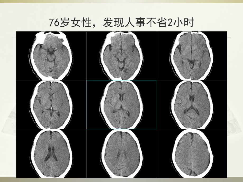 脑梗死CT表现课件.pptx_第3页