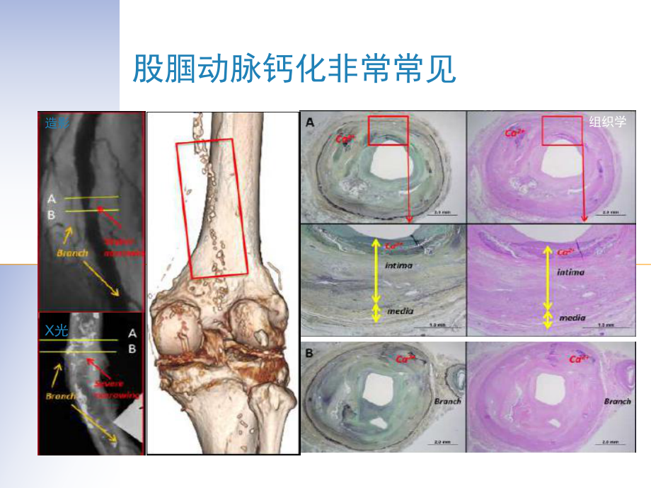 股腘动脉钙化病变治疗方法选择课件.ppt_第2页