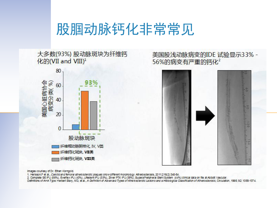 股腘动脉钙化病变治疗方法选择课件.ppt_第3页