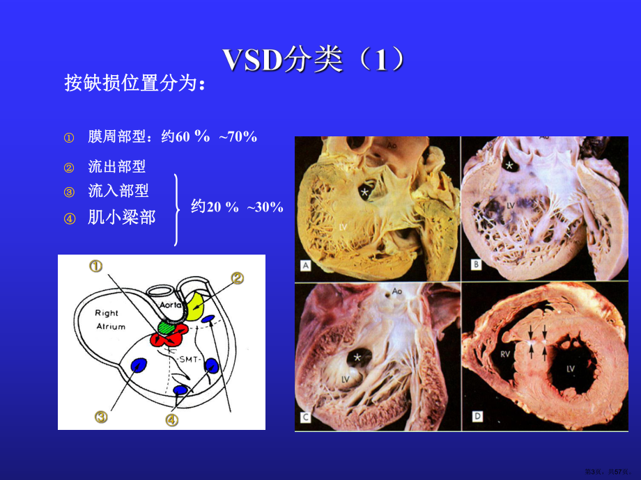 (儿科学课件)第十三章先天性心脏病(VSdtofPDA)(PPT 57页).pptx_第3页