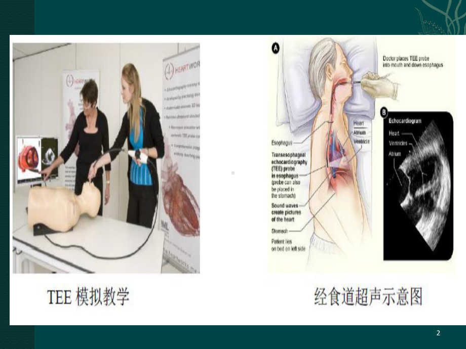 食道超声医学PPT课件.pptx_第2页