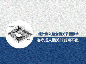 经外侧入路全髋关节置换术治疗成人髋关节发育不良课件.pptx